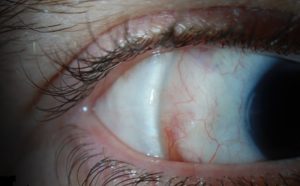 baton rouge general retina detachment surgery