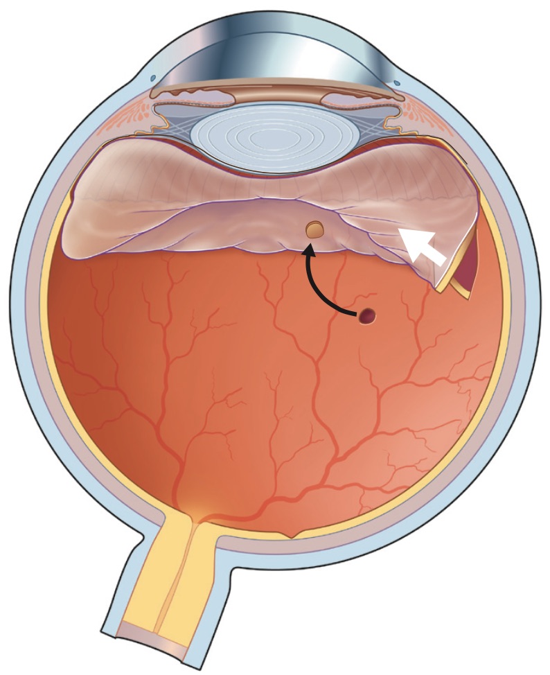 Замена сетчатки. Пузыревидная отслойка сетчатки. Регматогенная отслойка сетчатки. Разрыв сетчатки (retinal tear). Кт глазном яблоке отслоение сетчатки кт.