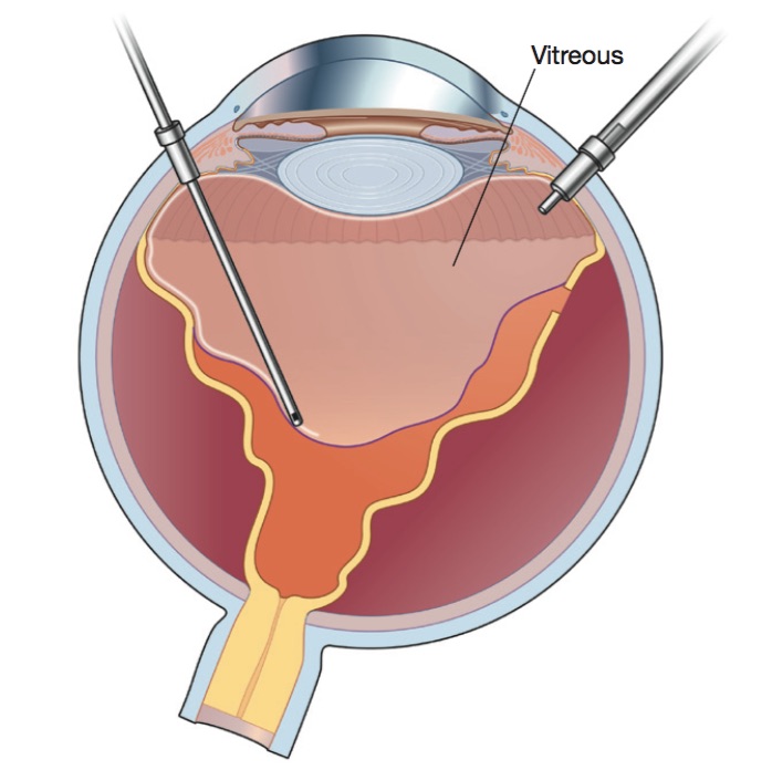 Vitrectomy is a Core Operation of a retina specialist | Orange County | Shahem Kawji MD