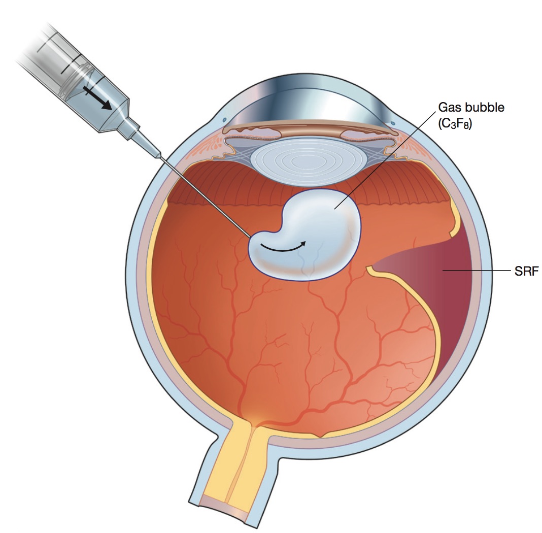 Vitrectomy performed by retina specialist Shahem Kawji MD | Orange County CA 92660
