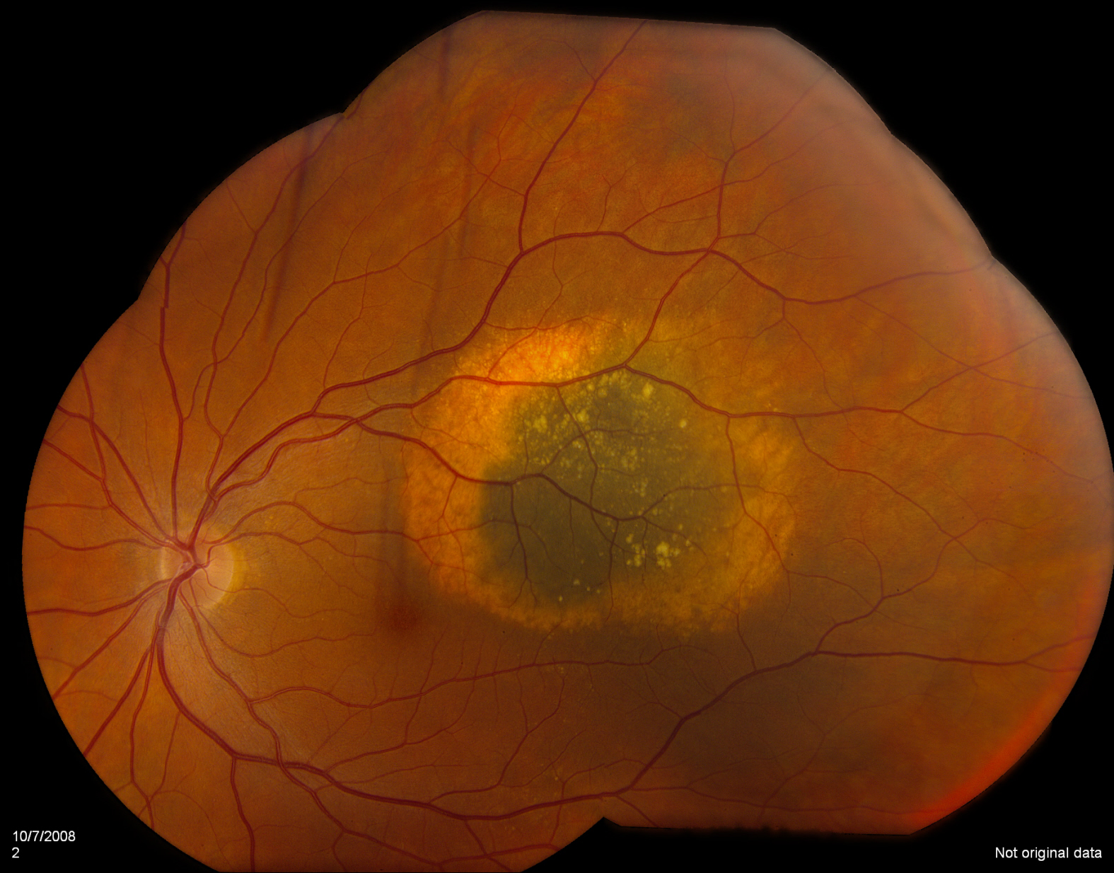Choroidal Nevus | Benign Retinal Lesion | Shahem Kawji MD Retina Specialist Orange County