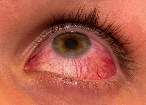 Uveitis | Red Irritated Eyes | Retina Specialist Orange County | Shahem Kawaji, MD