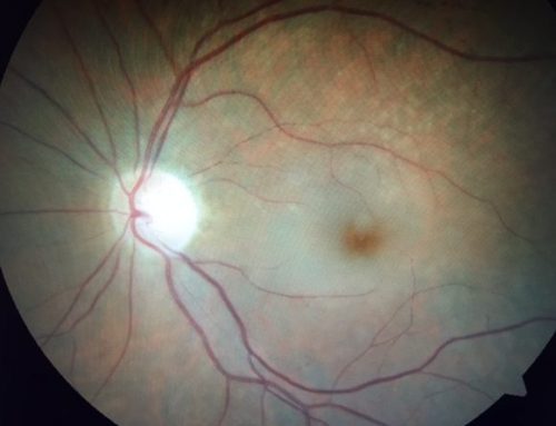 Retinal Artery Occlusions