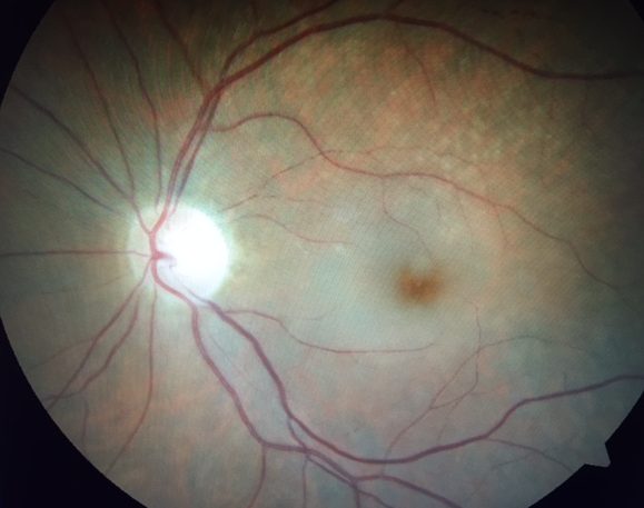 Central Retinal Artery Occlusions CRAO | Orange County Retina Specialist | Shahem Kawji MD